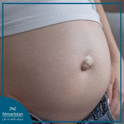 Umbilical Hernia in Women | Cause and Treatment - Bimaristan