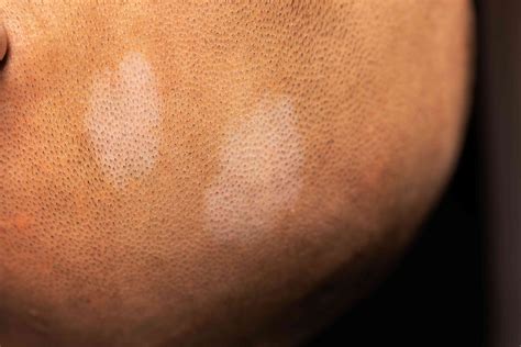 Birthmarks: Types, Causes, and How to Care for Them