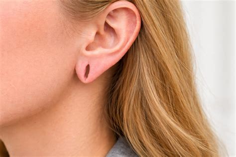 Will Hair Grow Back After Pilar Cyst Removal? | Aventus Clinic