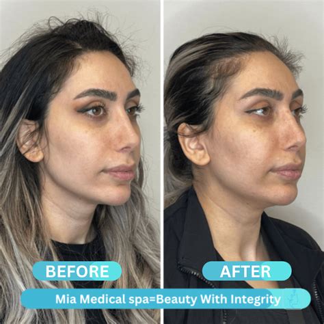 Before & After in Beaverton, OR | Mia Medical Spa