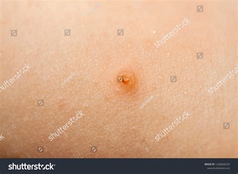 Close Molluscum Contagiosum Called Water Wart写真素材1236666535 | Shutterstock