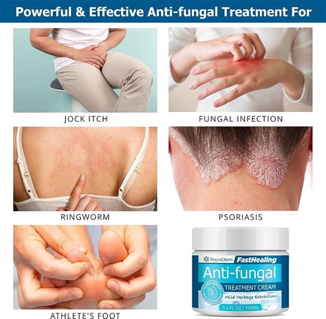 Roycederm Antifungal Cream - Maximum Strength Treatment for Athletes ...