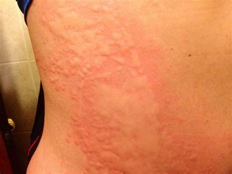 What Are Hives Skin at Arthur Dwyer blog