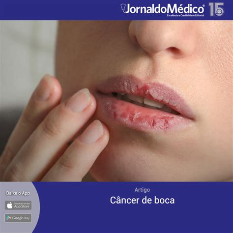 Câncer de boca | Jornal do Médico®