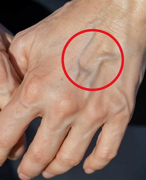 If Veins Suddenly Pop Out on Your Hands