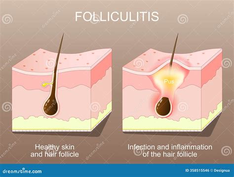Inflamed Hair Follicles