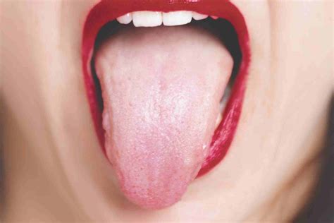 Scalloped Tongue: Causes, Symptoms, and Treatment