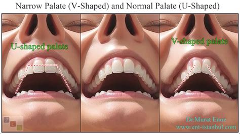Causes, Symptoms and Treatment of "High-Arched Palate"