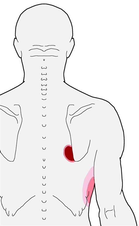 Nagging Pain Inside The Bottom of the Shoulder Blade - Integrative Works