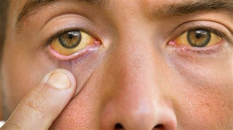 Liver Failure Symptoms