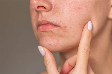 Perioral Dermatitis Triggers and Treatment | Bragan Skincare