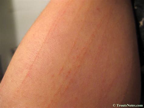Why Do I Have Red Lines On My Arms at Abigail Fawsitt blog