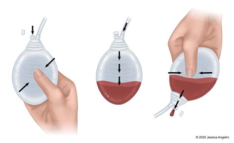 Jackson Pratt Drain Insertion Drains & Hemostatic Agents: