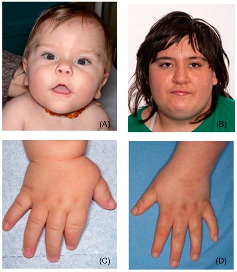 Smith-Magenis Syndrome—Clinical Review, Biological Background and ...