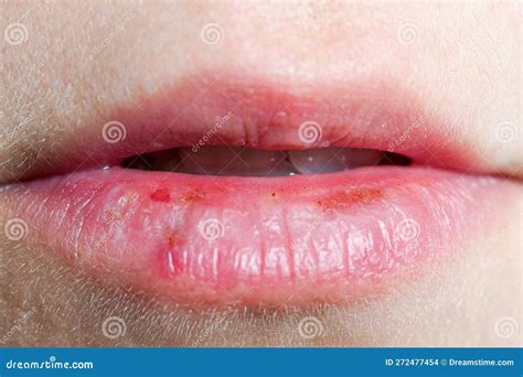 How To Fix Dry Cracking Lips at Crystal Molden blog