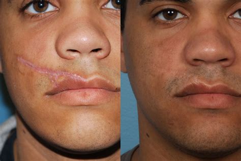 Scar Revision Before And After 11 Weber Facial Plasti - vrogue.co