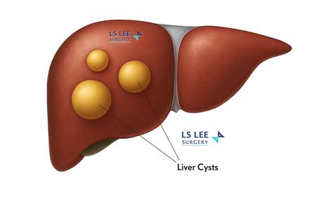 Liver Cystic Tumour Treatment In Singapore | LS Lee Surgery Clinic
