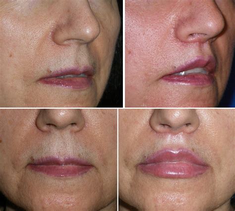 Lip Lift Anatomy at Paul Jamison blog
