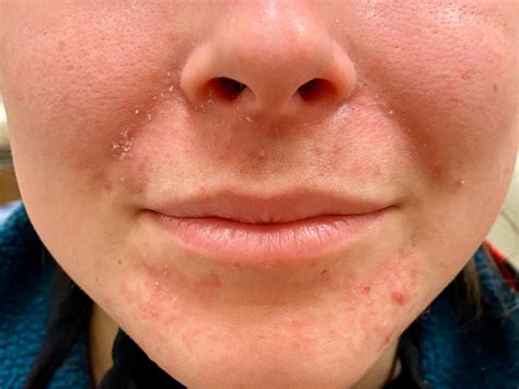 Why Do I Have Acne Around My Lips | Lipstutorial.org