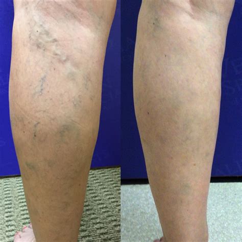 Sclerotherapy Is a Less-Invasive Way To Get Rid of Spider Veins - Vein Specialists of the Carolinas