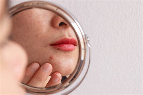 How to Treat Those Pesky Pimples Around Your Mouth | Software