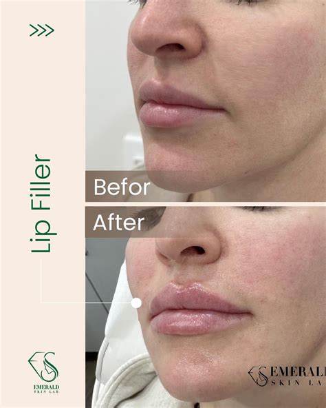 Lip Fillers Before & After Photos | Emerald Skin Lab | Toronto