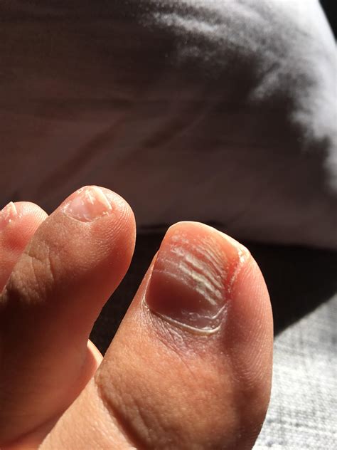 Why Do My Toenails Have Deep Ridges at Steven Hines blog