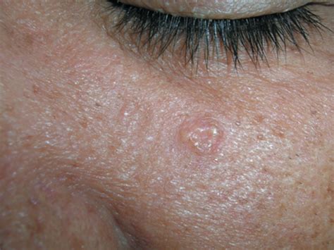 Sebaceous Hyperplasia Treatment