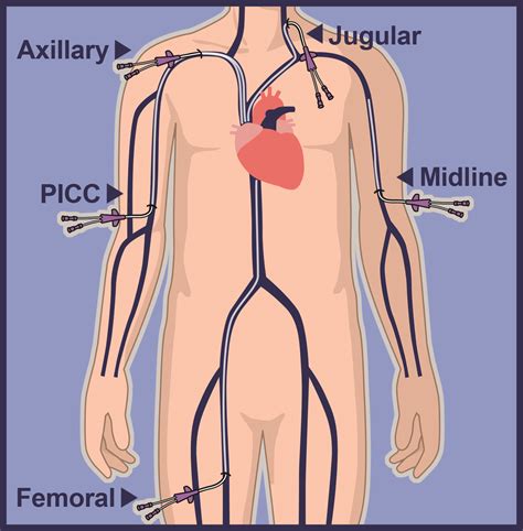 Central Venous Catheter