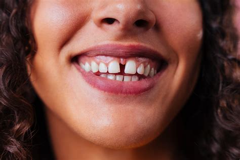 How to Fix a Gap Between Your Teeth | Norwest Orthodontics & Hills ...