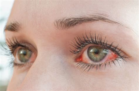 Should Dry Eye Drops Sting? | Forsee Eyecare