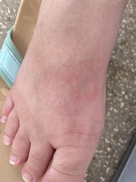 Rash on top of foot : r/DermatologyQuestions