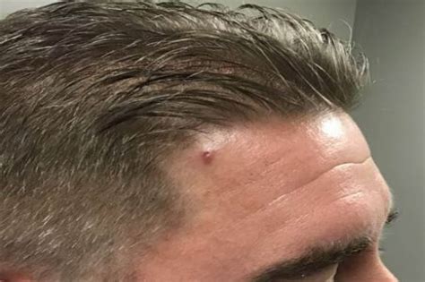 DermDx: Nodule on Temple - Dermatology Advisor