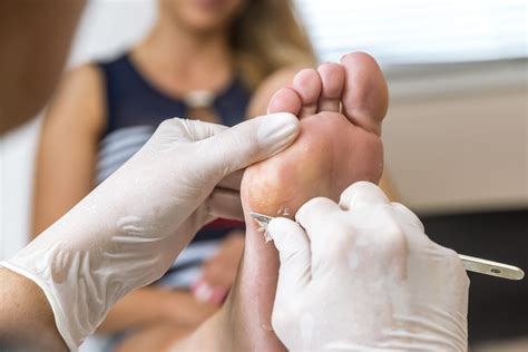 Corns And Callus Treatment - Top Tips - The Healthcare Hub