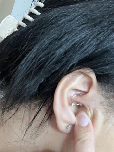 Nipple Piercing Keloid Remedy at Zoe Burdett blog