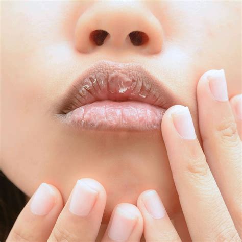 How To Avoid Dry Lips - Hirebother13