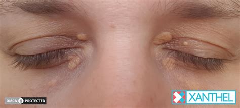 Cholesterol Deposit Removal - Xanthelasma