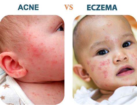 Baby Acne On Chest