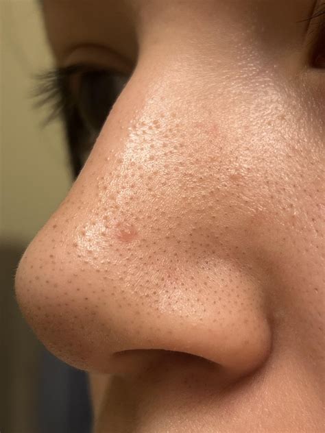 Blackheads or Sebaceous Filament? : r/SkincareAddicts