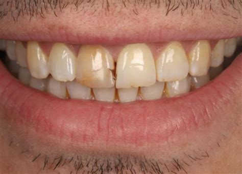 Gum Abscess Popped? Thinking of Popping It Yourself?