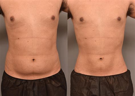 Smartlipo™ Laser Liposuction in NYC & Manhattan