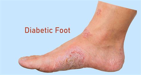 Diabetic Feet - Natural Remedies - My Emerald Health