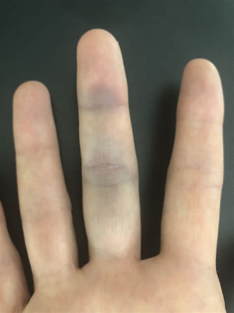 Bruised Middle Finger