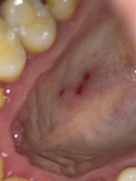 Oral Herpes Roof Of Mouth Herpes | Aidsmap