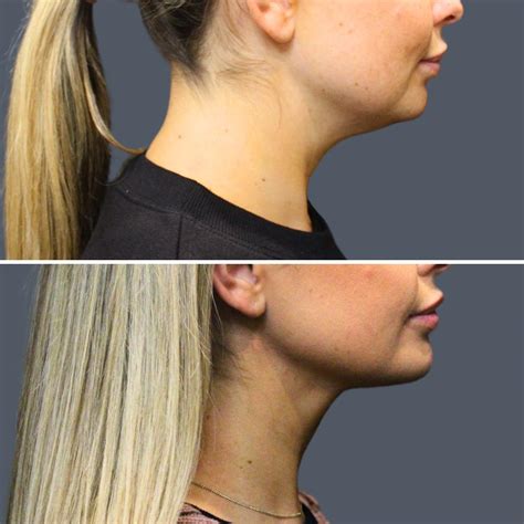 Smart Lipo Chin: Comprehensive Guide To Sculpting Your Jawline – SIKY