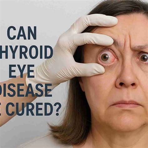 Can Thyroid Eye Disease Be Cured? What Science Says | Credihealth