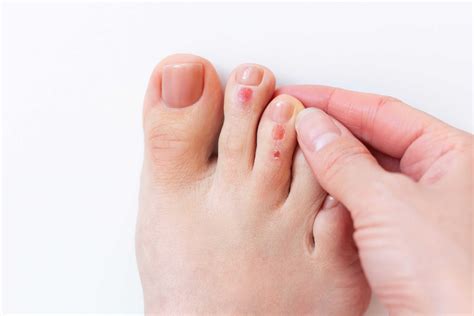 How To Deal With Blisters On Feet: A Stepbystep Guide