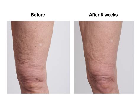 Crepey Skin On Legs