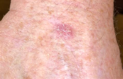 Actinic Keratosis