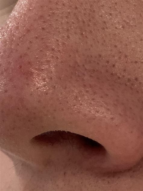 Infected Pores On Nose